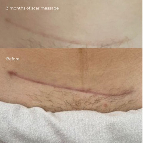 scar before and after massage